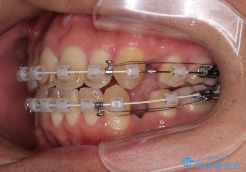 【モニター】前歯のデコボコと口元の出っ張りを改善!目立たない矯正で自然な笑顔にの治療中