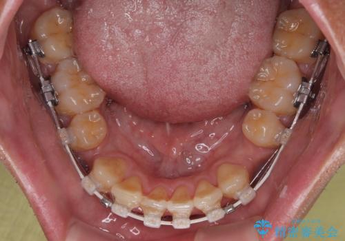 【モニター】前歯のデコボコと口元の出っ張りを改善!目立たない矯正で自然な笑顔にの治療中