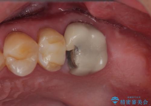 欠損した奥歯 インプラントによる補綴治療の症例 治療前