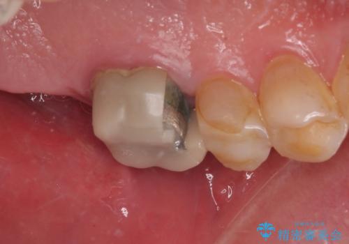 欠損した奥歯 インプラントによる補綴治療の治療前