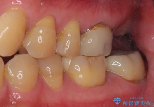 欠損した奥歯 インプラントによる補綴治療の治療前