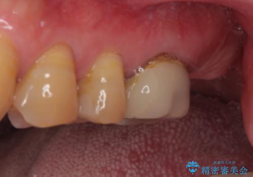 欠損した奥歯 インプラントによる補綴治療の治療前