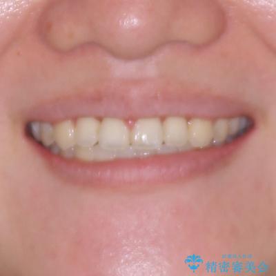 急速拡大装置 狭い歯列を拡大してクロスバイトを短期間矯正治療の治療後(顔貌)