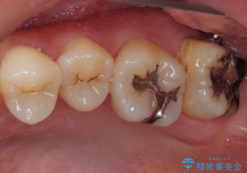 矯正治療で移動を終えた歯 オールセラミッククラウンでのむし歯治療の治療前