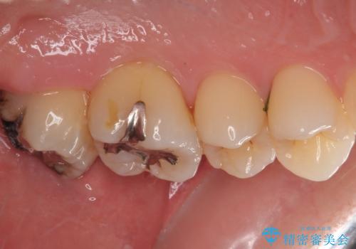 矯正治療で移動を終えた歯 オールセラミッククラウンでのむし歯治療の治療前