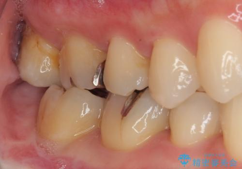 矯正治療で移動を終えた歯 オールセラミッククラウンでのむし歯治療の治療前