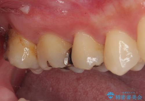 矯正治療で移動を終えた歯 オールセラミッククラウンでのむし歯治療の治療前
