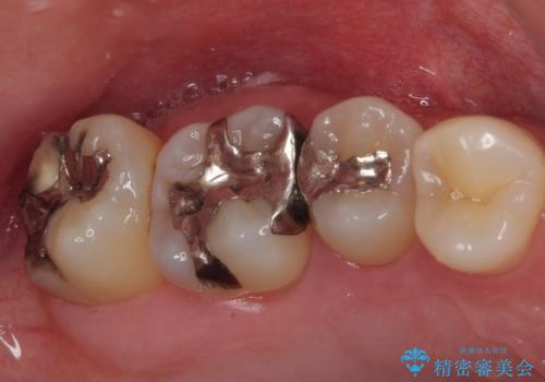 矯正治療で移動を終えた歯 オールセラミッククラウンでのむし歯治療