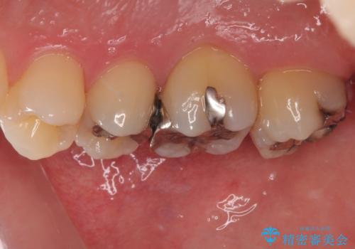 矯正治療で移動を終えた歯 オールセラミッククラウンでのむし歯治療の治療前