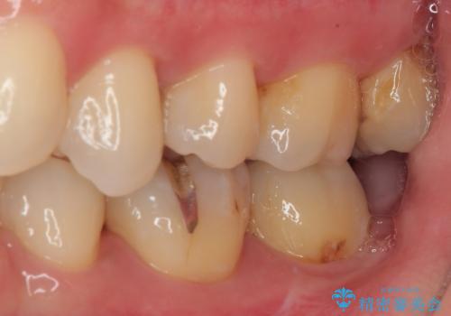 矯正治療で移動を終えた歯 オールセラミッククラウンでのむし歯治療の治療前