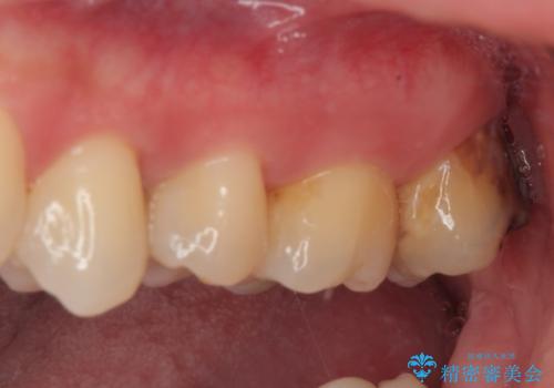 矯正治療で移動を終えた歯 オールセラミッククラウンでのむし歯治療の治療前