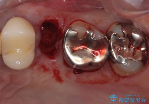 外科処置は一度だけ|抜歯即時インプラントで短期間で自然な見た目への治療前