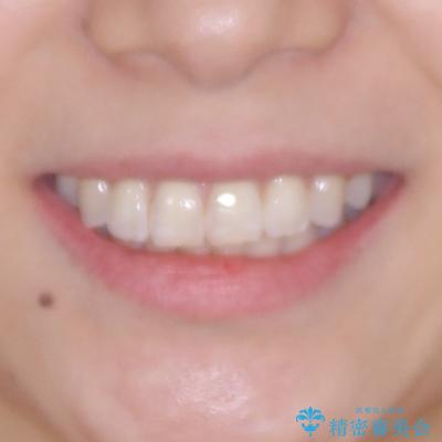 デコボコの非抜歯矯正 ワイヤー装置で楽して改善の治療後(顔貌)