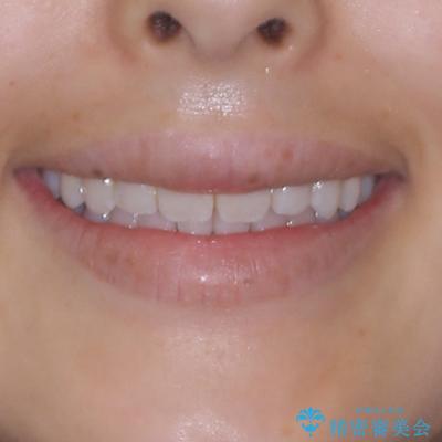 斜め前に飛び出した前歯 抜歯矯正で素敵な横顔にの治療後(顔貌)