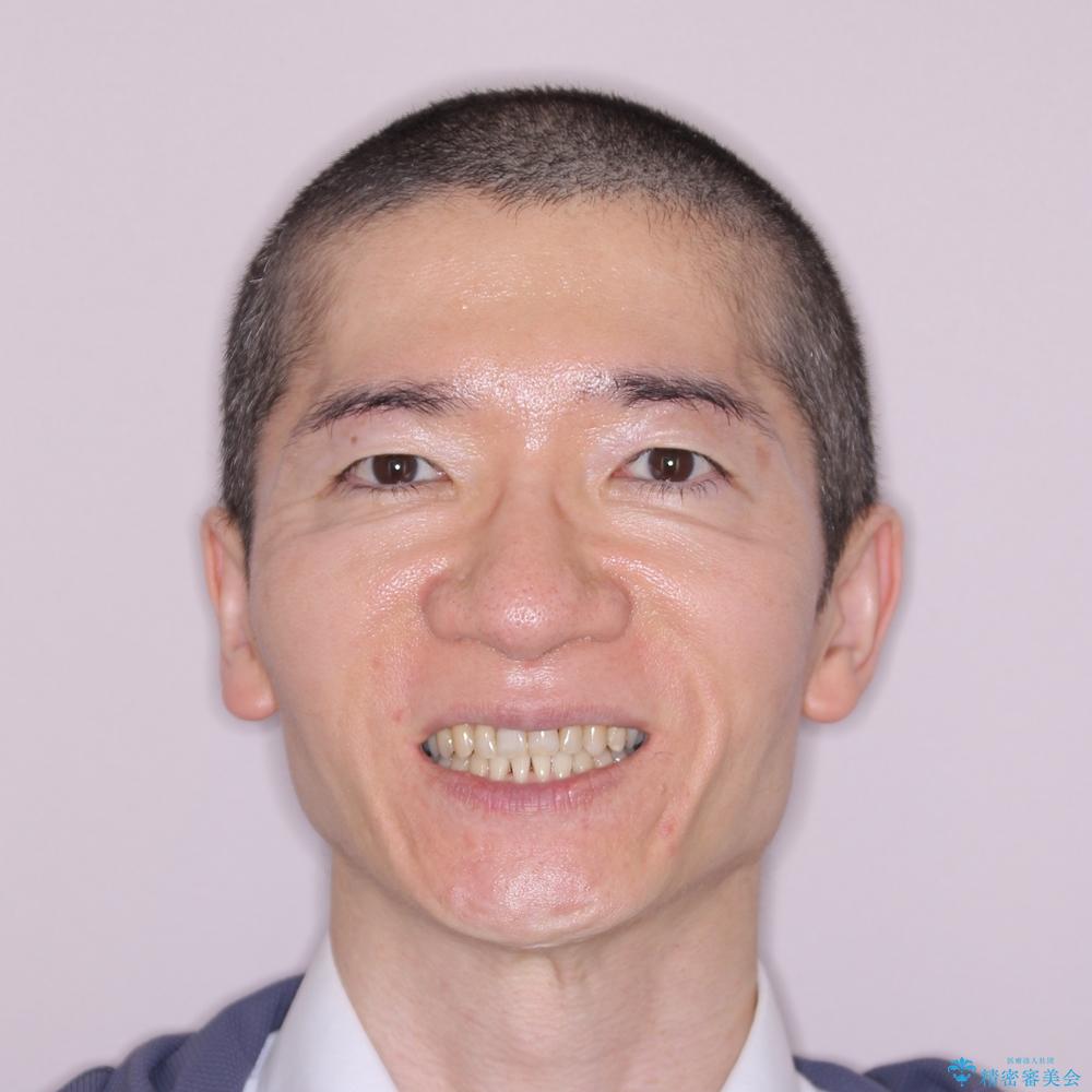 【モニター】ディープバイトで隙間の空いた歯列 ワイヤー装置での非抜歯矯正の治療後(顔貌)