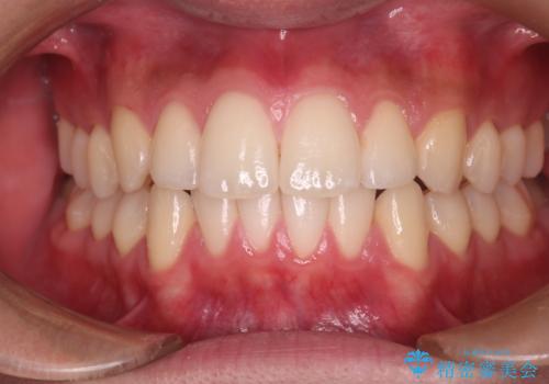 【インビザラインモニター】前歯が出ているのが気になるの症例 治療後