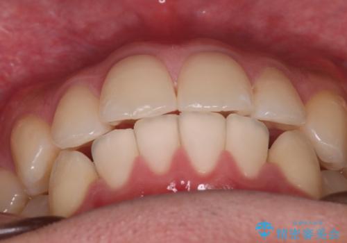 【インビザラインモニター】前歯が出ているのが気になるの治療後