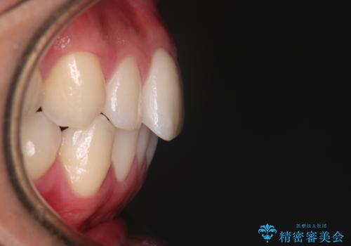 【インビザラインモニター】前歯が出ているのが気になるの治療後