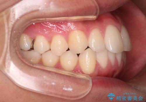 【インビザラインモニター】前歯が出ているのが気になるの治療後