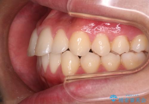 【インビザラインモニター】前歯が出ているのが気になるの治療後