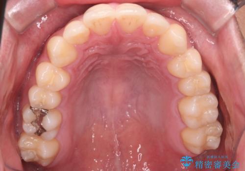 【インビザラインモニター】前歯が出ているのが気になるの治療後