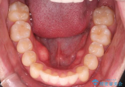 【インビザラインモニター】前歯が出ているのが気になるの治療後