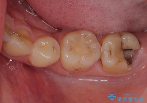 左下の奥歯が欠けた フルジルコニアクラウン・親知らず抜歯の症例 治療前