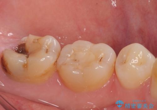 左下の奥歯が欠けた フルジルコニアクラウン・親知らず抜歯の治療前