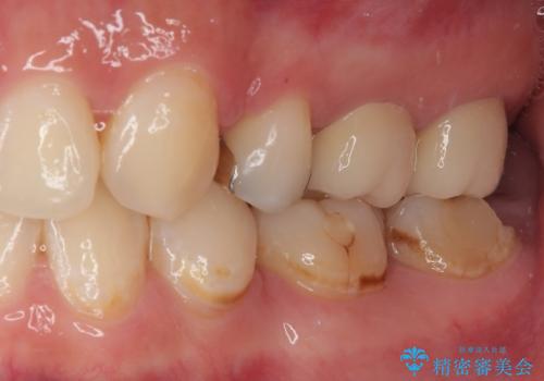 左下の奥歯が欠けた フルジルコニアクラウン・親知らず抜歯の治療前