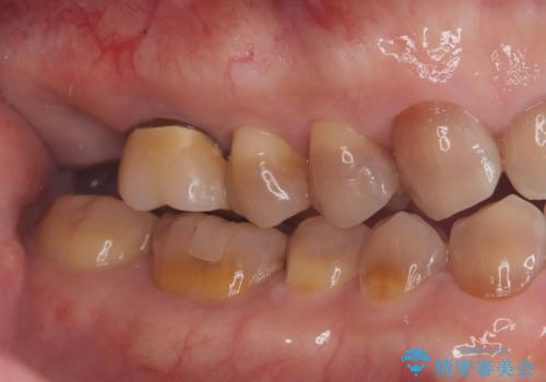 根尖性歯周炎|歯根嚢胞|インプラント治療の治療中