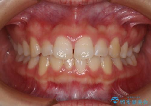 前歯のガタつきを治したい インビザライン・ライトパッケージの治療前