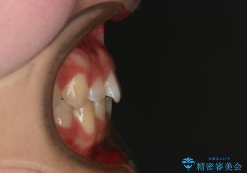 前歯のガタつきを治したい インビザライン・ライトパッケージの治療前