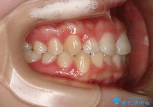 前歯のガタつきを治したい　インビザライン・ライトパッケージの治療前