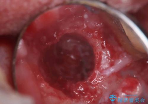 根尖性歯周炎|歯根嚢胞|インプラント治療の治療中