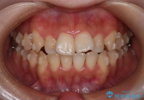 【インビザライン】マウスピースで開咬改善の治療中