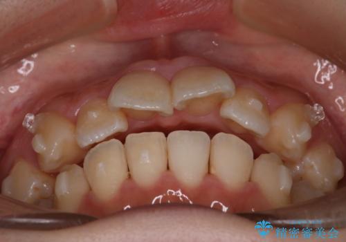 【インビザライン】マウスピースで開咬改善の治療中