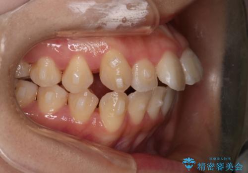 【インビザライン】マウスピースで開咬改善の治療中