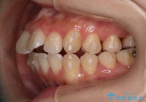 【インビザライン】マウスピースで開咬改善の治療中