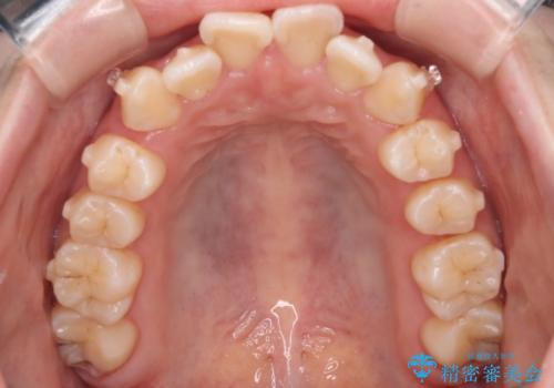 【インビザライン】マウスピースで開咬改善の治療中