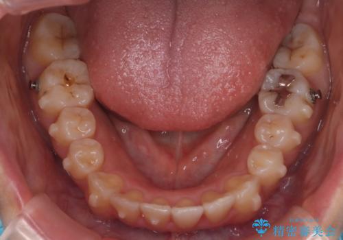 【インビザライン】マウスピースで開咬改善の治療中