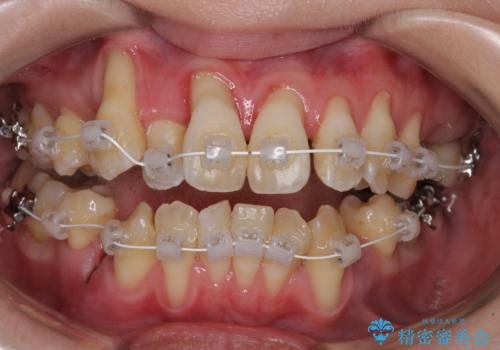 急速拡大装置 狭い骨幅を拡大した上で、顕著なデコボコを改善する抜歯矯正治療の治療中