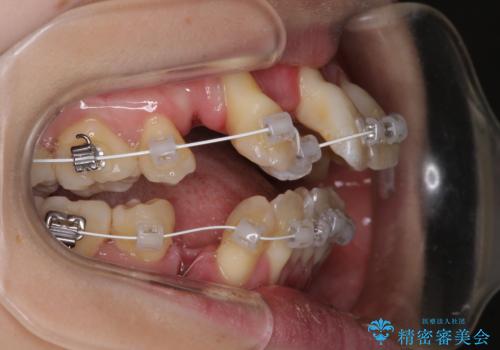 急速拡大装置 狭い骨幅を拡大した上で、顕著なデコボコを改善する抜歯矯正治療の治療中