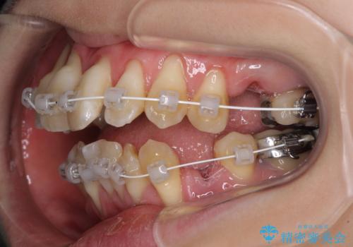 急速拡大装置 狭い骨幅を拡大した上で、顕著なデコボコを改善する抜歯矯正治療の治療中