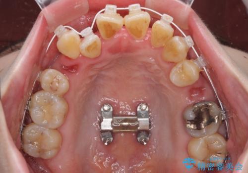 急速拡大装置 狭い骨幅を拡大した上で、顕著なデコボコを改善する抜歯矯正治療の治療中