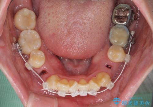 急速拡大装置 狭い骨幅を拡大した上で、顕著なデコボコを改善する抜歯矯正治療の治療中