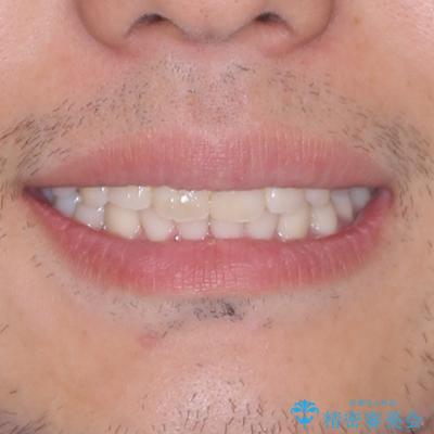 デコボコをインビザライン矯正で改善 奥歯は補助装置で確実に移動をの治療後(顔貌)