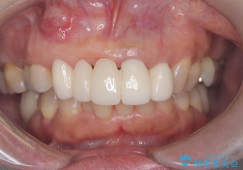 歯茎の腫れが気になる方必見!|抜歯即時インプラントで前歯5本を痛みなく3か月で治療完了!の症例 治療前