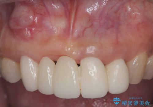 歯茎の腫れが気になる方必見!|抜歯即時インプラントで前歯5本を痛みなく3か月で治療完了!の治療前