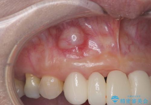 歯茎の腫れが気になる方必見!|抜歯即時インプラントで前歯5本を痛みなく3か月で治療完了!の治療前