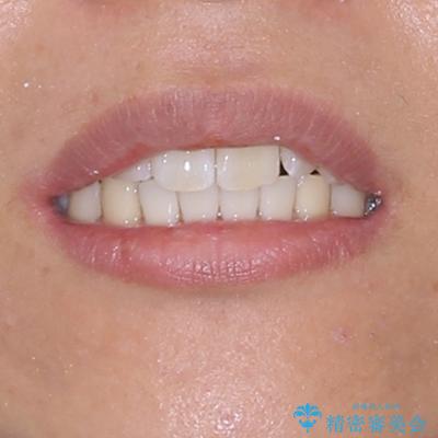 前歯のデコボコをインビザラインで綺麗に改善の治療後(顔貌)